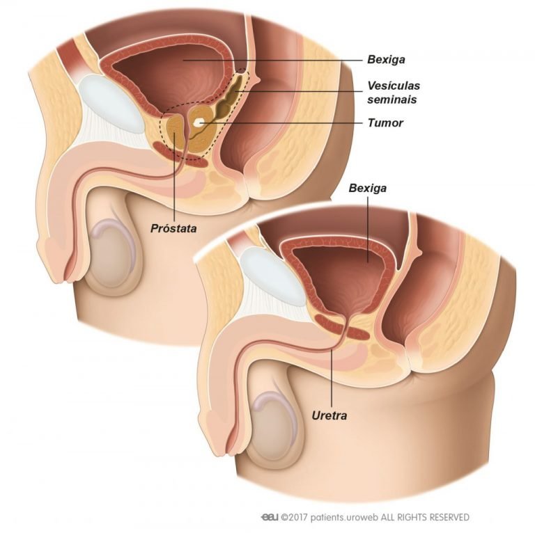 Câncer de Próstata e Impotência: a Ereção após a cirurgia