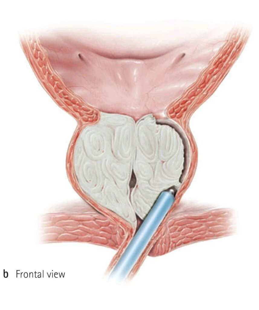 Holep – Tratamento da próstata aumentada com laser