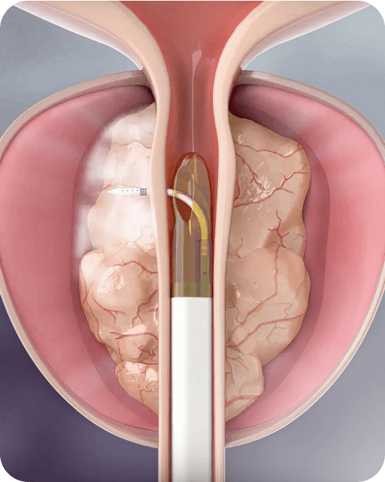Rezum – Tratamento Menos Invasivo da HPB